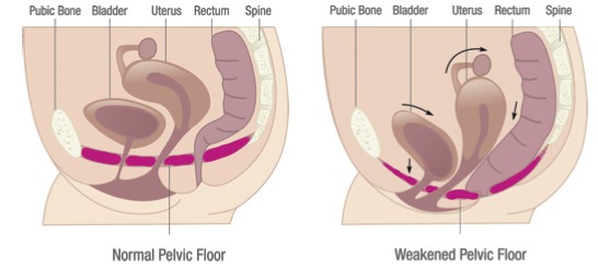 Pelvic Organ Prolapse